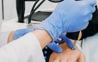 sposoby usuwania brodawek