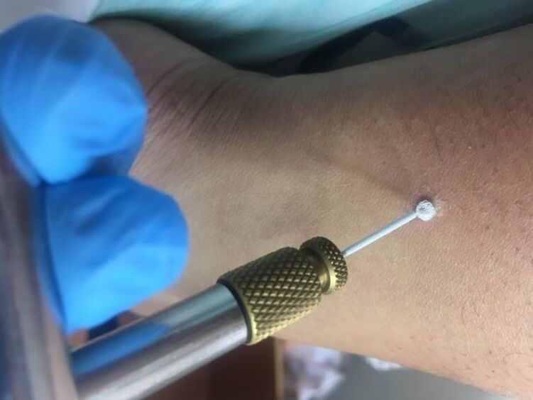 sposoby usuwania brodawek