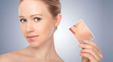 przegląd skutecznych środków na brodawki i brodawczaki