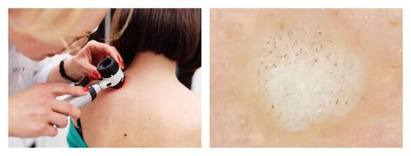 Dermatoskopia brodu