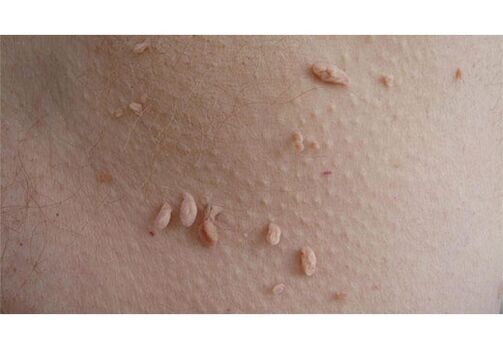 Oznaką zakażenia HPV jest pojawienie się brodawczaków na ciele